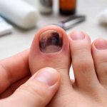 Ongle de pied noir sans choc
